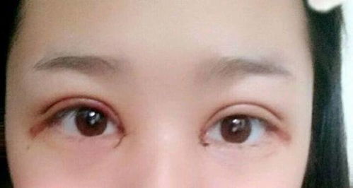 割双眼皮后无法闭眼 女子崩溃发声