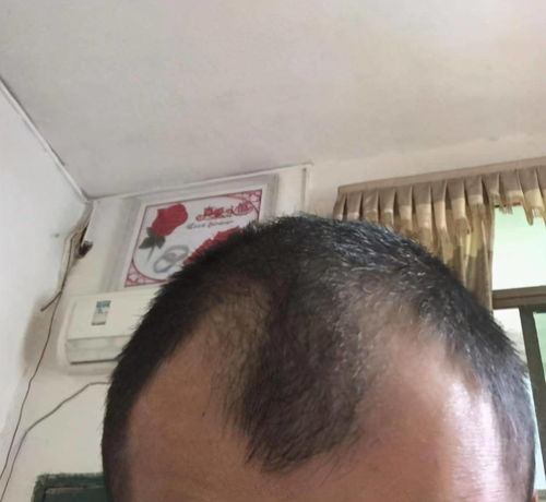 19岁男子脱发严重查出梅毒