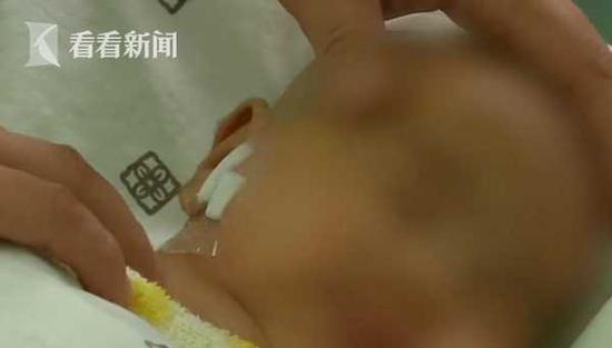 男子撸铁后擦汗 脸部感染“脚气”